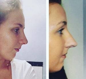 nose job before and after on a young lady