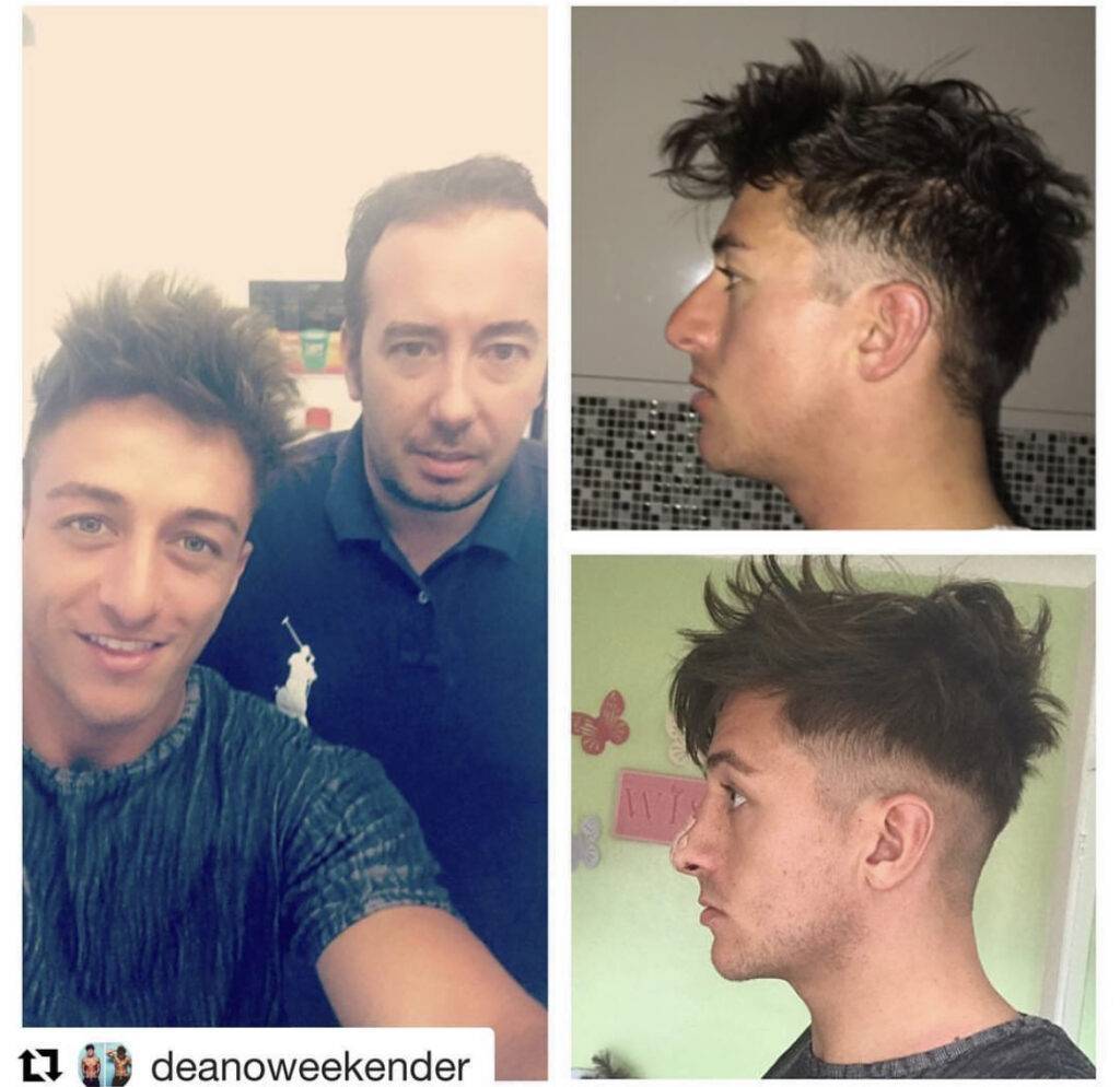 rinoplastica prima e dopo su una celebrità