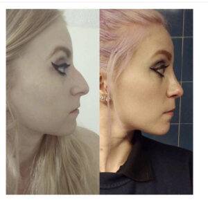 nose job before and after on a lady