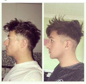 nose job before Ana after of a man two images