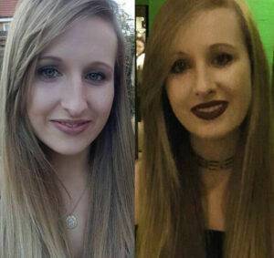 a young woman showing her nose job before and after