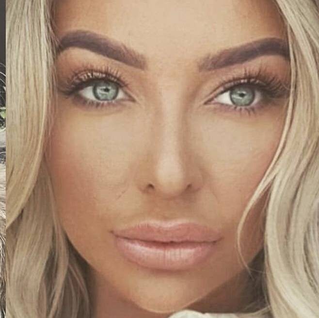 Rhinoplasty cost and result on a woman's face